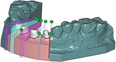 Dental Scanning Software - EXOCAD